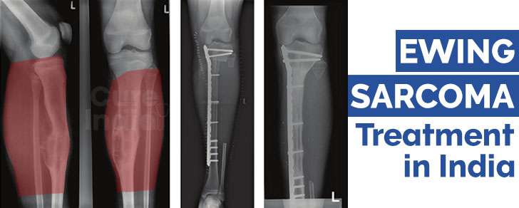 Ewing Sarcoma Treatment in India